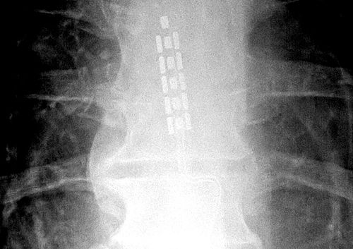 Spinal cord stimulator
